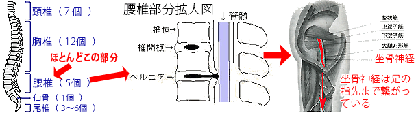 椎間板ヘルニア・坐骨神経痛のメカニズム