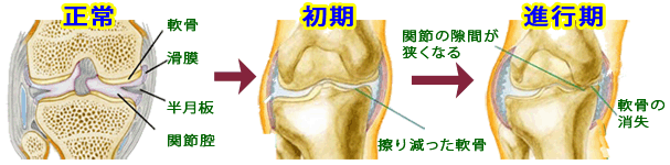 膝痛・関節痛の原因