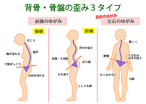 背骨・骨盤の歪み３タイプ