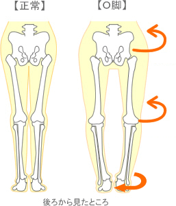 Ｏ脚の原因